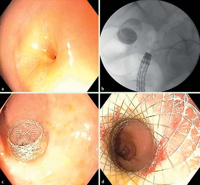 E100 THIEME Fig. 5 a Short, tight, benign gastroduodenal stricture. b,c Endoscopic view of lumen-apposing, double-flanged, fully covered SEMS in the pyloric channel.