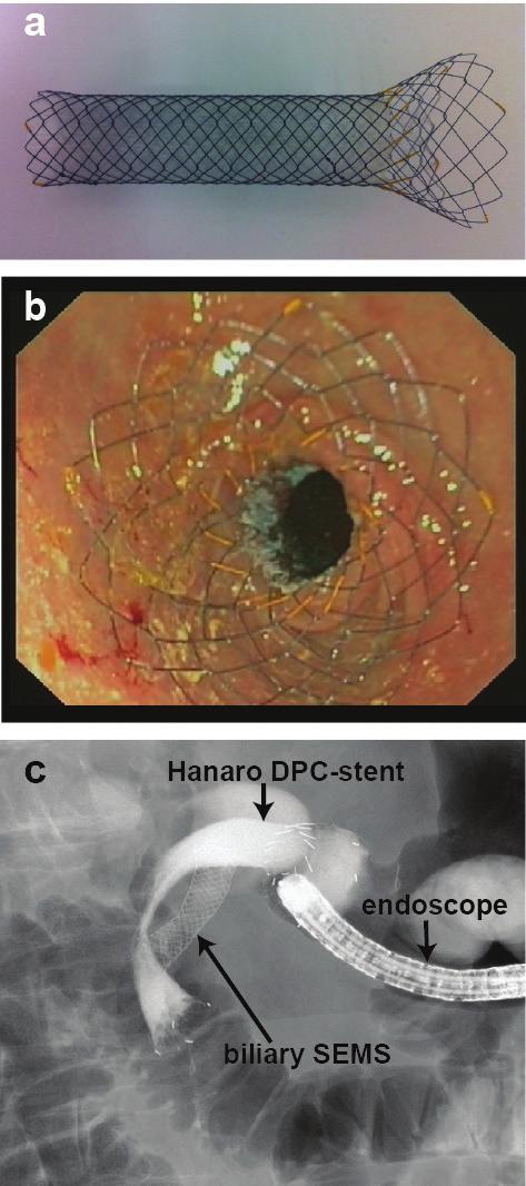 Proximal migrations with new duodenal stent for malignant GOO 7 Figure 1 a) Picture of the Hanaro DPC-stent b) Endoscopic view of the