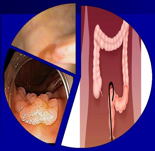 CAUSES of COLON PERFORATION Frequency Fecal Diversion 27% 18% 55% 62.5 50 37.5 25 12.5 0 2.