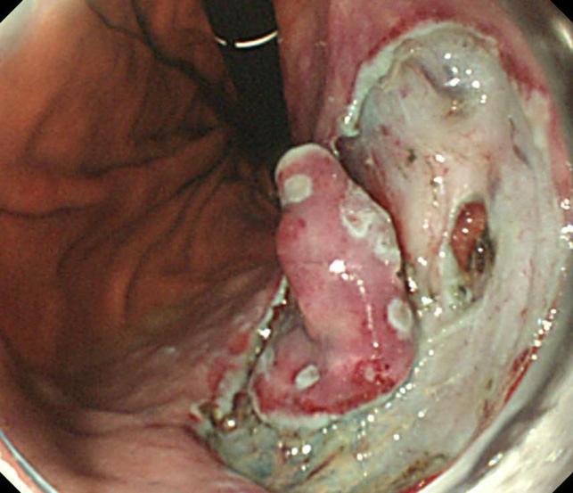 3%) of 117 patients with gastric perforations were successfully