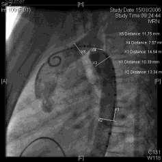 The pressure gradient between ascending aorta and descending aorta across the coarctation site and pullback gradients across it were measured.