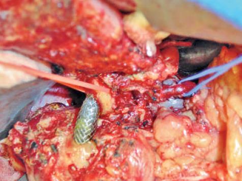 Malignant common bile duct strictures Pre-operative biliary drainage Is necessary?
