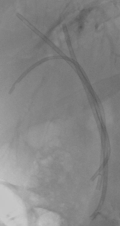 Which stents for malignant hilar biliary strictures palliation?