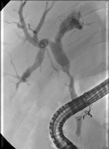 Stenting in