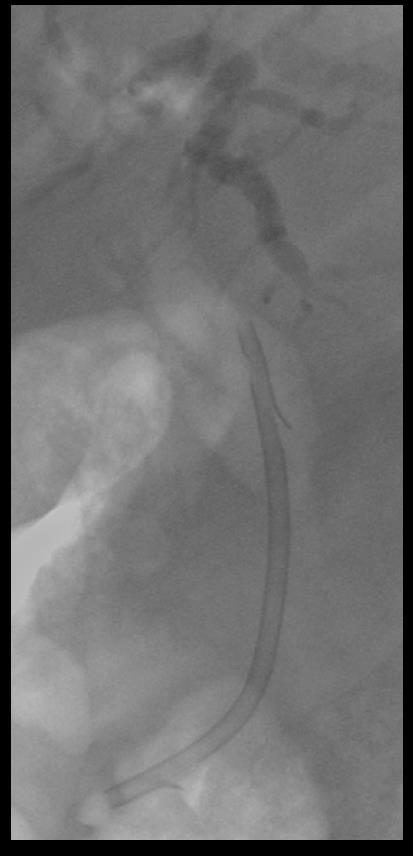 Malignant common bile duct strictures