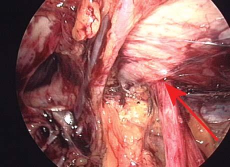Changes of important anatomical structures in the inguinal region after a herniorrhaphy: observations during treatment of recurrent hernia using TEP parallel to the inguinal ligament.