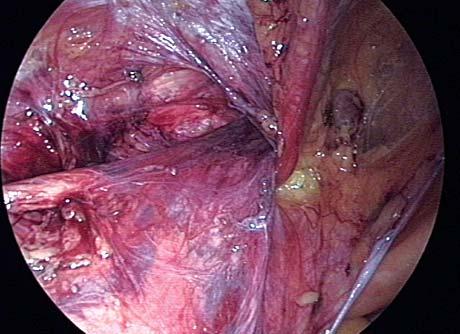 Anton Scierski i wsp. Fig. 4. Primary inguinal hernia on left side. The retroparietal spermatic sheath is a stable layer which encloses the spermatic vessels laterally and the vas deferens medially.