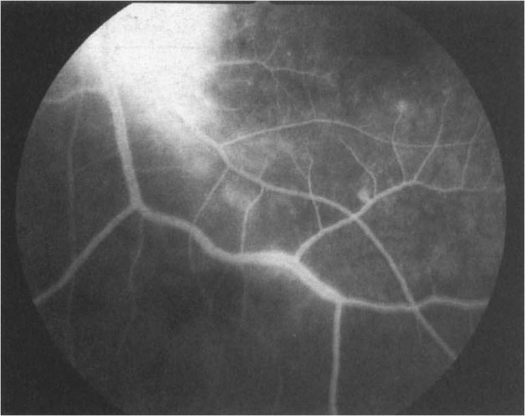 Fig. 1. Case 1: idiopathic chorioretinitis. Late fluorescein angiogram of the left inferotemporal arcade and optic disc showing marked fluorescein leakage from the disc and retinal vein. Fig. 2.