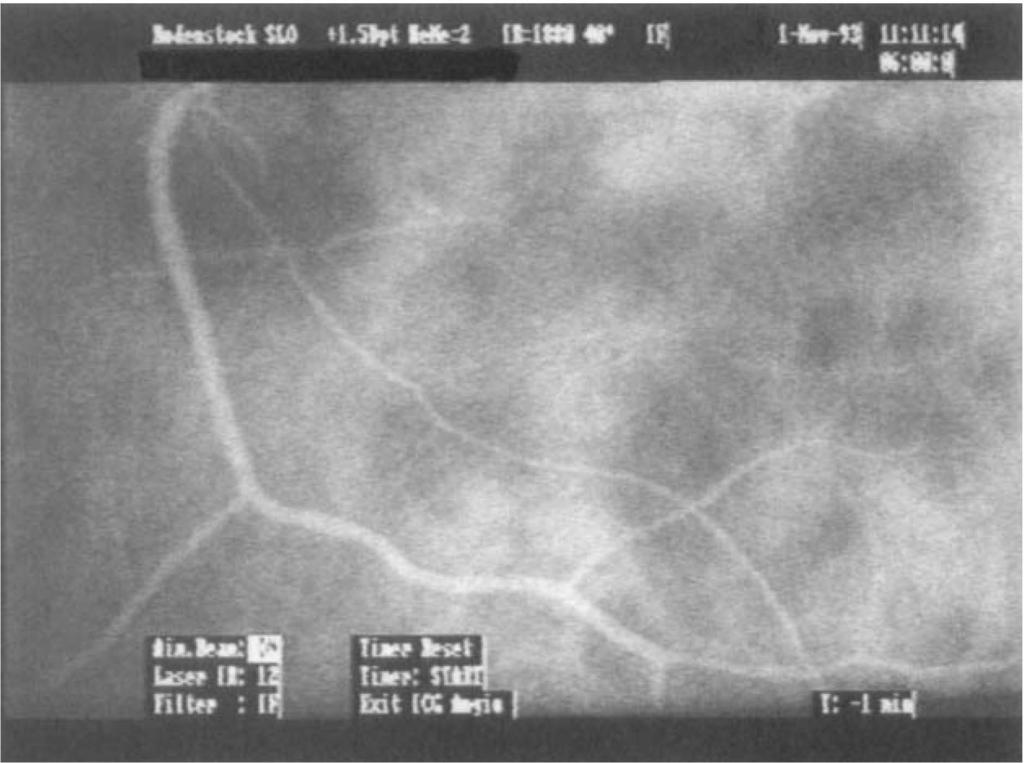 Fluorescein angiogram of the area temporal to the left macula showing marked retinal capillary drop-out in the periphery. Fig. 4. Case 2: severe ischaemic retinal vasculitis.
