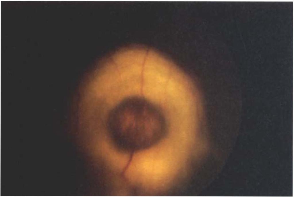 Fig. 5. Case 3: idiopathic choroiditis. Colour photograph of right fundus showing elevated doughnut-shaped choroidal lesion. Fig. 6. Case 3: idiopathic choroiditis. Fluorescein angiogram in the late venous phase showing hyper fluorescence of the doughnut-shaped choroidal lesion shown in Fig.