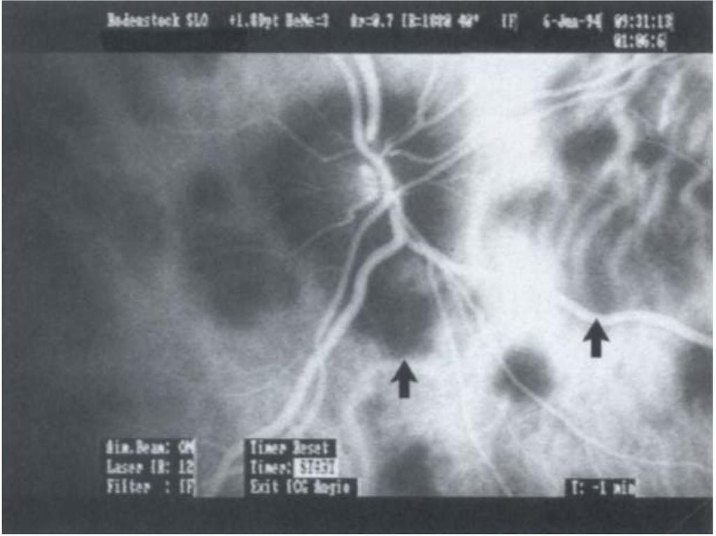 lcg angiogram showing multiple dark areas that correspond to the lesions seen clinically (arrows indicate same lesions highlighted on