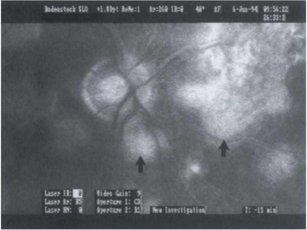 Fig. 12. Case 4: idiopathic choroiditis. Late lcg angiogram showing persistence of the hypo fluorescent areas.