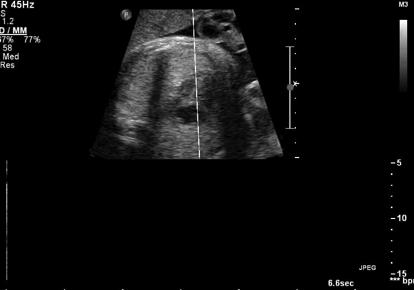 !1! All had extrasystoles on prenatal scan! Proper Management! Current standard:!!fetal echocardiogram!!weekly auscultation! Alternative:!