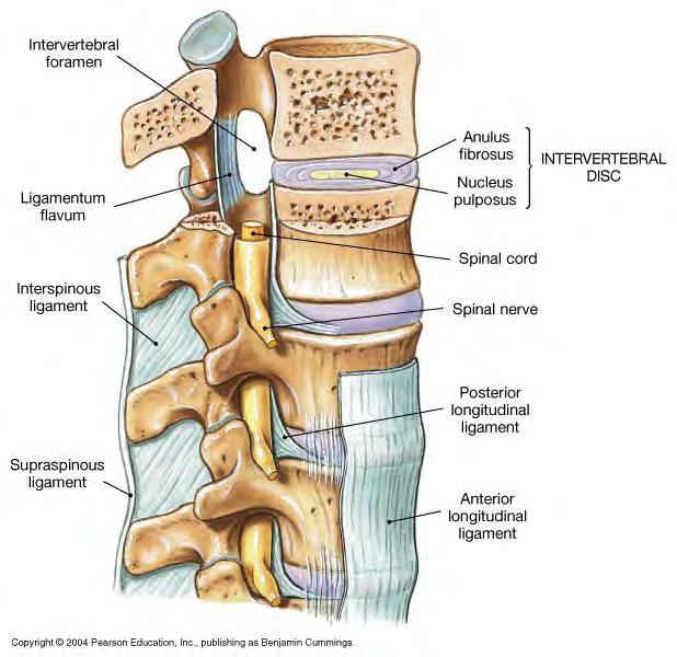 foramen and/or spinal cord in vertebral canal Slipped disc = intervertebral disc distorted