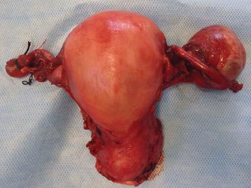 Post-opertive photos of tumor confirm the sence of invsion outside the uterus (, c) It is well known tht t CC stges II IV chemordiotherpy is the min