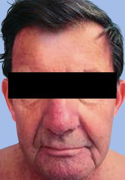 Patients typically experience a sensory facial disturbance with edema soon after initiation