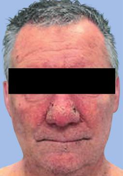 This is followed by a papulopustular eruption localized to the face and upper trunk.