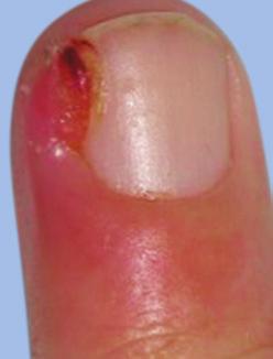 5-7 Can be associated with tenderness 1,6,7 May mimic ingrown