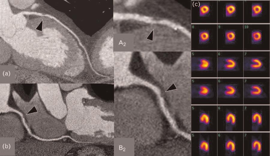 New imaging techniques in CAD Multislice computed tomography Since the introduction, in 1998, of multislice scanning using four detector rows, the technique has undergone an extremely rapid