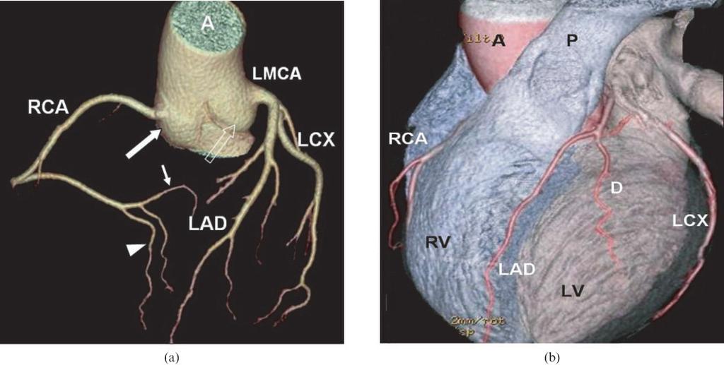 Pictorial review: Assessment of coronary artery anomalies with MDCT between the bulbus and the ascending aorta, i.e. at the sinotubular junction.
