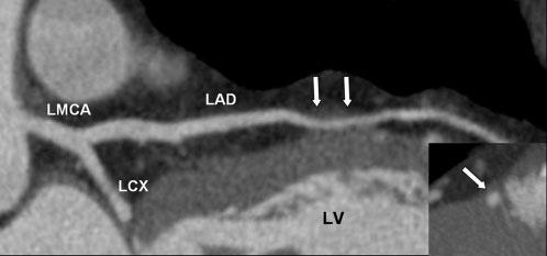 A R Zeina, J Blinder, D Sharif et al Figure 2. A 53-year-old man with multiple ostia and separate origins of the right coronary artery (RCA) and conus branch (CB).
