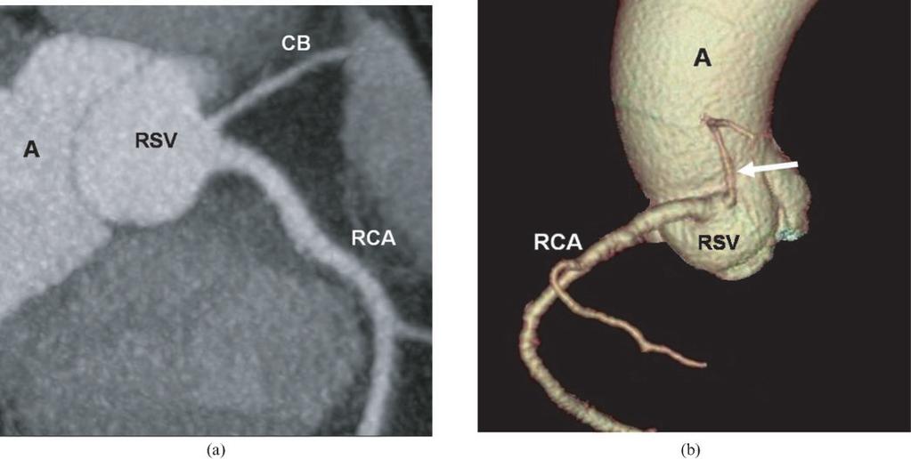 (b) Three-dimensional volume-rendered image of the aortic root (A) shows the separate origin of the conus branch (arrow) from the RSV.