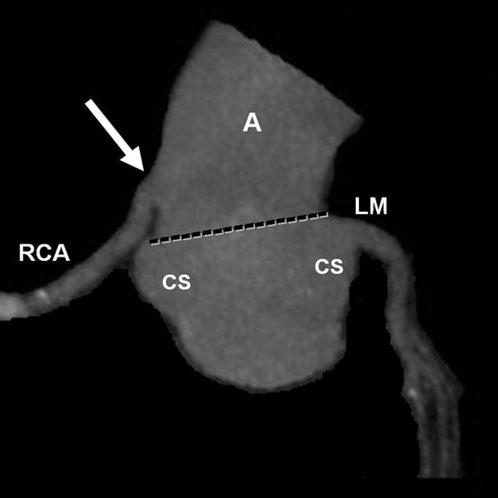 Pictorial review: Assessment of coronary artery anomalies with MDCT Figure 4.