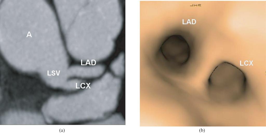 (a) Thick slab maximum intensity projection multidetector CT image shows the absence of the left main coronary artery, with separate ostia of the LAD and LCX arteries from the left sinus of Valsalva