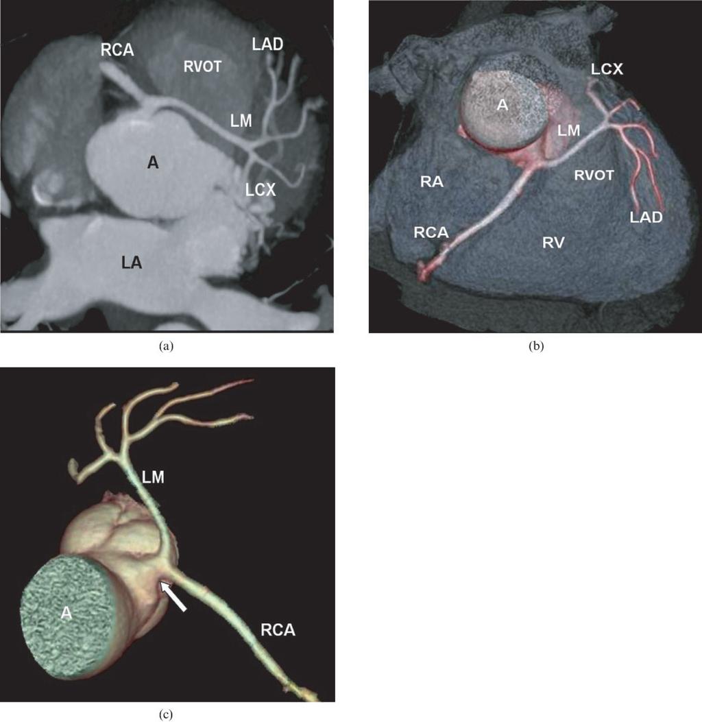 A R Zeina, J Blinder, D Sharif et al Figure 6. A 58-year-old man with a single coronary artery.