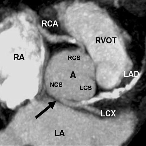 Pictorial review: Assessment of coronary artery anomalies with MDCT Figure 7. A 58-year-old man with a left main artery arising from the non-coronary sinus (NCS).