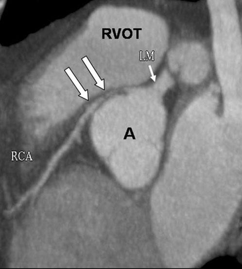 Note that the right coronary artery (RCA) arises normally from the right coronary sinus (RCS). No coronary artery is arising from the left coronary sinus (LCS).