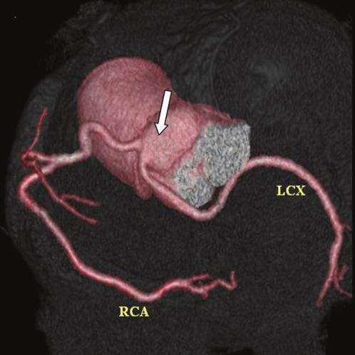 Cardiac transparency multidetector CT image shows the LCX arising separately close to the origin of the right coronary artery (RCA) from the right coronary sinus (arrow) and coursing below and behind