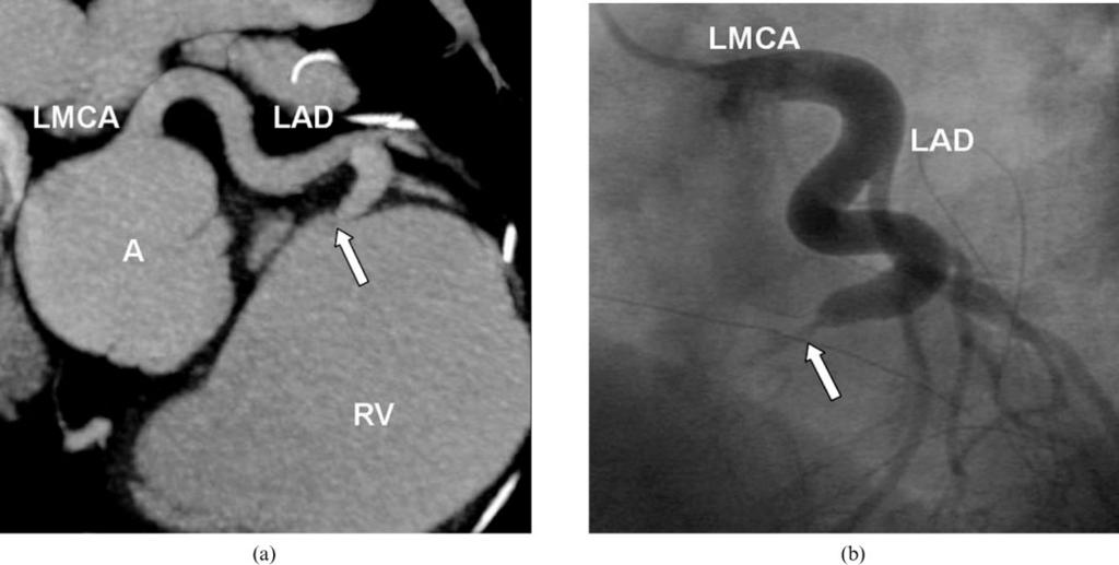A R Zeina, J Blinder, D Sharif et al Figure 10. A 26-year-old woman with total correction of the Tetralogy of fallot and a congenital left anterior descending artery (LAD) right ventricle fistula.