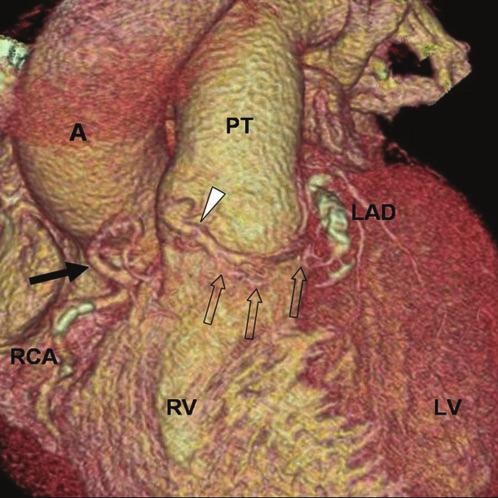 A, aorta; LMCA, left main coronary artery. (b) Left coronary angiogram shows a coronary artery fistula arising from the proximal LAD artery and emptying into the RV (arrow).
