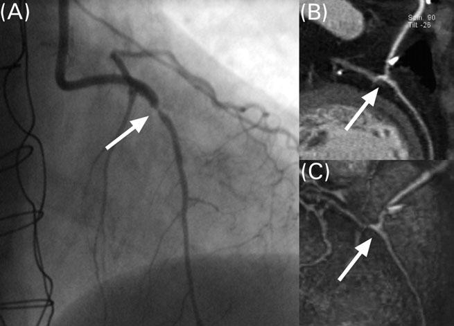 978 G. Pache et al. by ICA were two venous grafts, one to the left circumflex artery (LCX) and one to the right coronary artery (RCA). Both grafts were easily depicted and classified patent by MSCT.