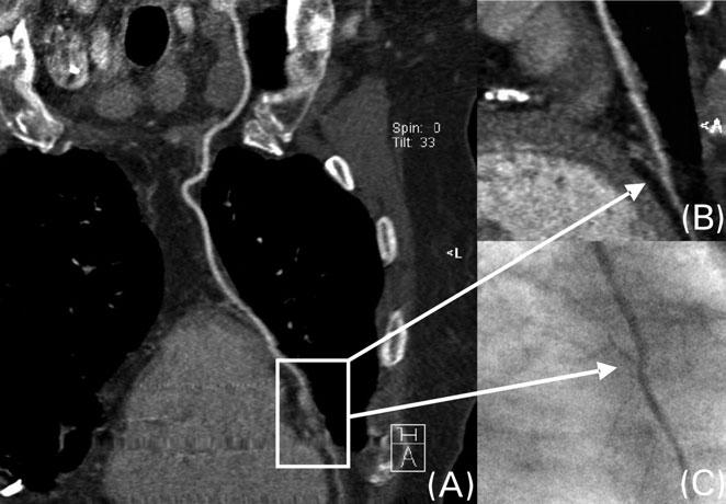 64-slice CT CABG angiography 979 Table 3 Diagnostic accuracy of MSCT for the detection of significant stenosis or occlusion of bypass grafts Arterial grafts (n ¼ 22) Venous grafts (n ¼ 71) True