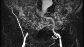 Abdominal Aortic Aneurysm Majority of AAA s are the result of atherosclerosis (other causes include trauma, infection and inflammation) Abdominal Aortic Aneurysm 10th leading
