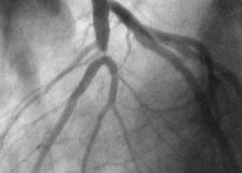 Issues Do coronary calcifications predict outcome?