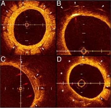 Atherosclerotic Intima 5 years after BMS Normal intima Cholesterol