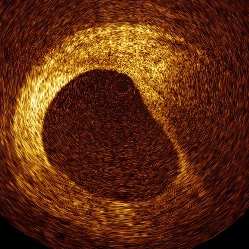Feasibility of combined use of IVUS-VH
