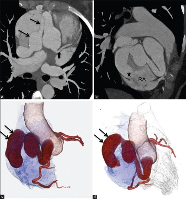 (a-d) Curved multiplanar reformatted contrast-enhanced computed tomography images (a and b) show a large and tortuous of right coronary artery (CA) fistula (arrows) draining into the right atrium in