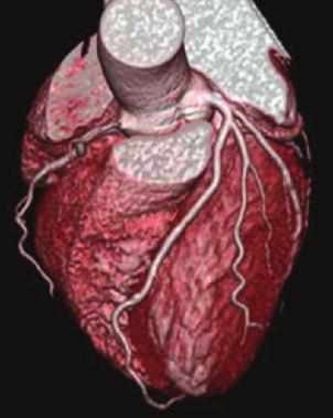 inexpensive, and easy-to-perform method of reliably determining whether coronary calcification is present or absent.