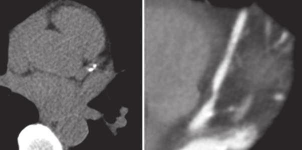 a Figure 2 Images obtained by cardiac CT. a A coronary artery calcium scan from a 45-year-old man with a family history of premature coronary heart disease.