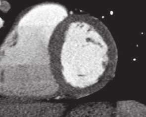 a b c Figure 4 CT myocardial perfusion images. The patient was a 63-year-old man with a history of hypertension and dyslipidemia who had experienced a syncopal episode.