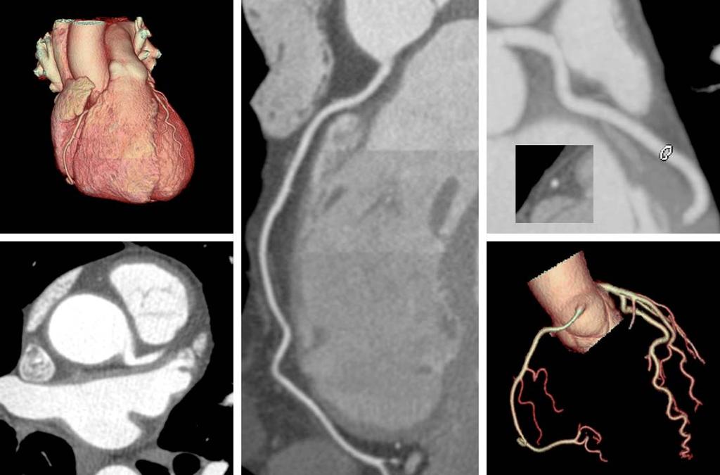Because of the complexity of coronary anatomy, the frequency of motion- and calcium-related image artifacts and the morphologic subleties of lesions, interpreters must review CCTA interactively on