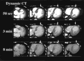 With Gd-DTPA enhanced T1-weighted imaging, abnormal enhancement of anteroseptal wall is evident that corresponds to LDA of CT (b).