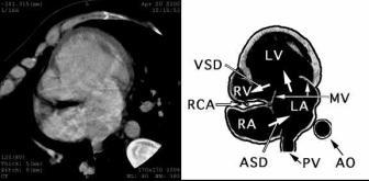 Superimposed images of PYP (red) and Tl (green) are also demonstrated (c). Same patient as above. Seven days after successful PTCA, 3-phase dynamic spiral CT was performed.