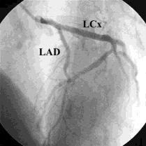 Imaging in Stented Coronary Arteries More difficult due to hyper-enhanced signals from the coronary stents, thus