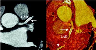 ISR Axial source and volume rendered images of the plad using end diastolic data in enhanced MSCT, showing a stent in