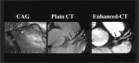B, Curved multiplanar reconstruction of the left main and circumflex coronary artery, again with the left main stenosis (arrow).